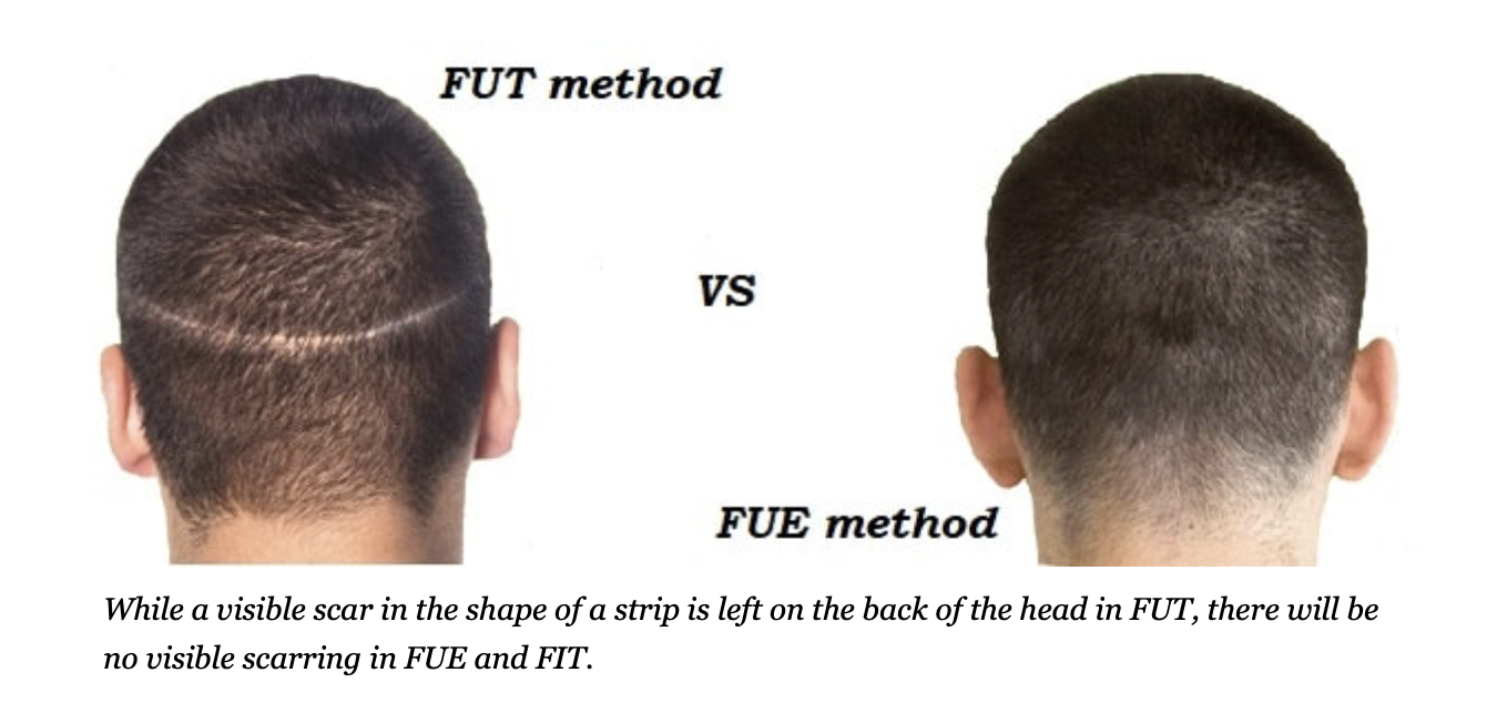 Fut vs Fue